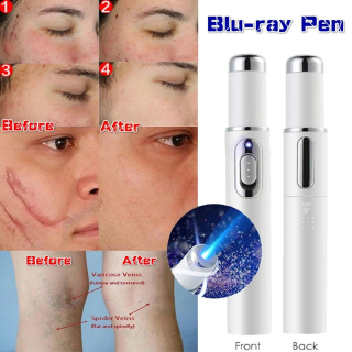 Caneta de luz azul para remoção de acne rugas cicatrizes - Cuidado facial