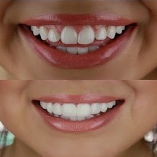 Upper Row De Dentes Brancos Definir Simulação Na Linha De Silicone De Prótese Set Folheados Flex Dentadura (5)