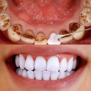 Higiene Bucal Clareadora Dental Para Clareamento De Dentes (1)