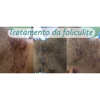 clareador foliculite axilas virilhas manchas acne cicatrizes picada de inseto (1)