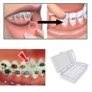 Cerinha para aparelho Dental Proteção para os Lábios