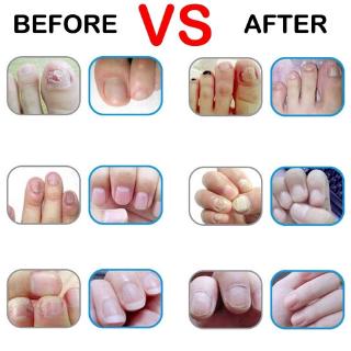 Prego Pen Onicomicose Paroníquia Infecção Herbal Dedo Dedo Do Pé Unhas De Saúde (5)