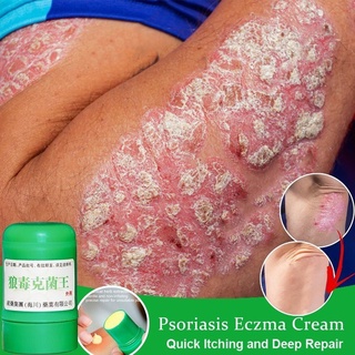 Creme para a pele Creme para psoríase Creme para a pele para psoríase Dermatite Eczema semelhante a eczema Tratamento pomada (4)