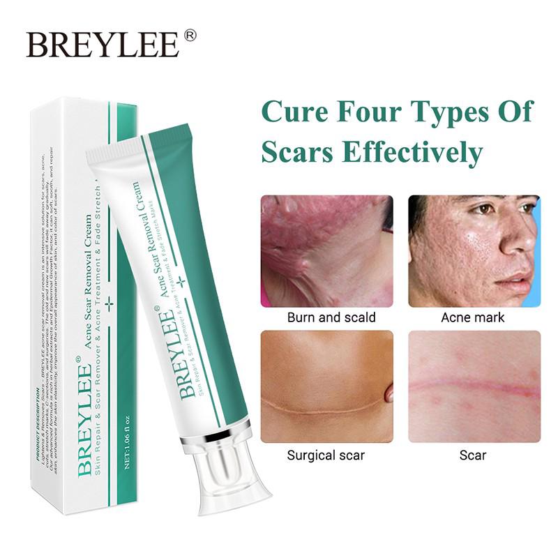 Creme BREYLEE Removedor e Clareador de Cicatriz e Estria, Cuidado com a Pele (1)
