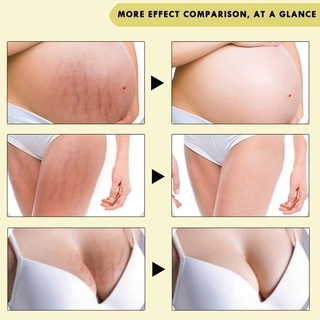 Stretch Marks And Scar Removal Stretch Marks Maternity Skin Body Repair Cream Remove Skin Care Products (6)