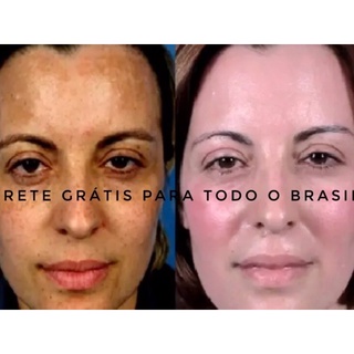 Clareador facial acne manchas melasma (peeling 10ml) postamos de imediato (4)