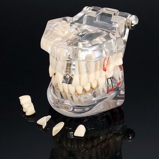 Modelo Dental Dissese Com Restauração Do Dente Da Ponte Dentista Para Medical Ciência Dental Disese Ensino Estudo Ferramenta