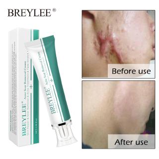 Creme BREYLEE Removedor e Clareador de Cicatriz e Estria, Cuidado com a Pele (2)