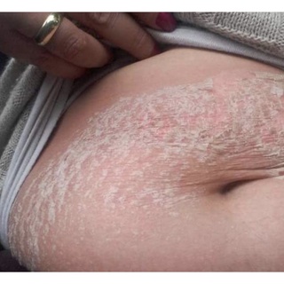 Clareador corporal (Manchas acne cicatrizes estrias axilas virilhas) (3)